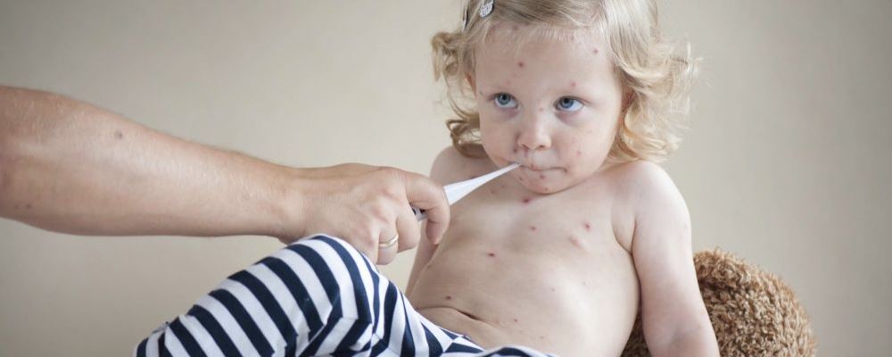 怎么辨别宝宝是否出水痘 水痘如何治疗 宝宝出水痘怎么办