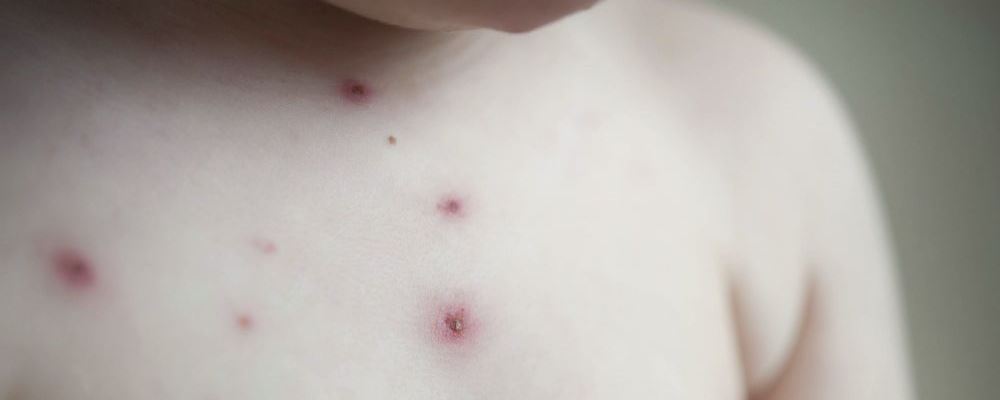 水痘是什么原因引起的 宝宝长水痘都有哪些症状 宝宝出水痘是什么原因